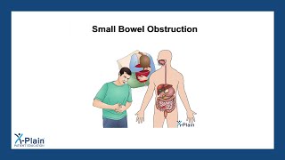 Small Bowel Obstruction [upl. by Camila]