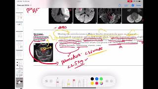 Neonatal intraventricular hemorrhage neurology 79  First Aid USMLE Step 1 in UrduHindi [upl. by Madlin544]