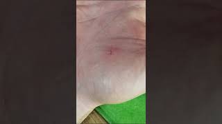 Pulling out the splinter with a sewing needle How to get rid of a splinter [upl. by Yanal]