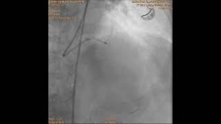 Rotational atherectomy in calcified coronary [upl. by Jepson]