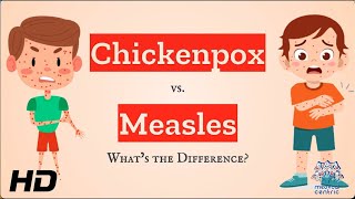 Chickenpox vs Measles Which is Which [upl. by Keiryt454]