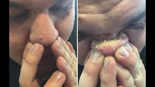 New Blackheads Removal NOSE Tuesday 30 January 2024 [upl. by Nibroc530]