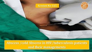 Session 115  Tuberculous Abscess in HIV patient [upl. by Trimble]