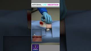 Arterial line insertion shorts [upl. by Poliard]