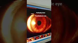 pseudophakia  ophthalmology case [upl. by Aitnis]