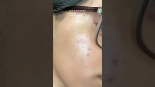 my 1 month tretinoin progress with acne prone skin [upl. by Oswald]