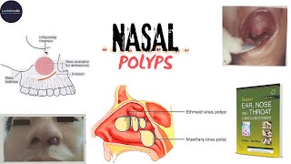 NASAL POLYPANTROCHOANALETHMOIDALETIOLOGYSSTREATMENT dhingra otorhinolaryngology udaipurwala [upl. by Ailehs953]