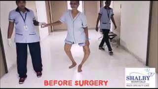 Witness the Power of Shalby’s quotZero Technique” Total Knee Replacement Surgery [upl. by Eenet]