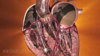 Heart Valve Implantation Full Procedure  Medical amp Scientific Video Production [upl. by Ahsiyk290]