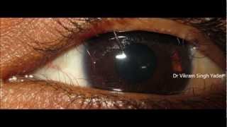 What Is Trichiasis [upl. by Nancie]