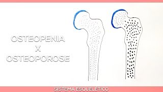 Diferença de Osteopenia e Osteoporose [upl. by Derwin153]