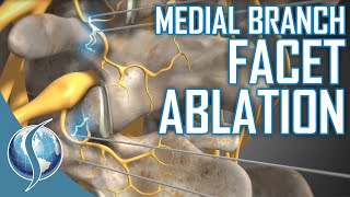 Medial Branch Facet Ablation [upl. by Wise883]