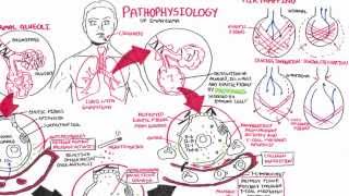 Emphysema  Pathophysiology COPD [upl. by Talyah]