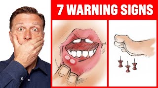 The 7 WARNING Signs of a B12 Deficiency  Dr Berg [upl. by Rennerb]