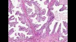 Histopathology ProstateIntraepithelial neoplasm PIN [upl. by Jarin]