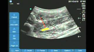 Ultrasound guided anterior sciatic nerve block [upl. by Ogdon]