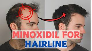 Minoxidil for Frontal Baldness  Restore Your Hairline [upl. by Annohsak317]