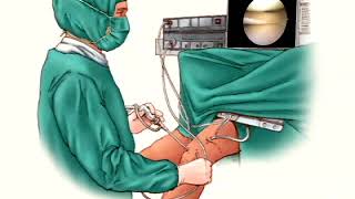 Arthroscopic knee surgery [upl. by Casaleggio638]