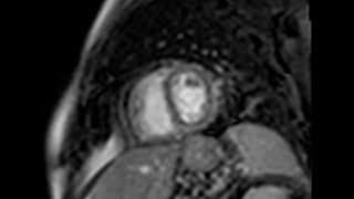 Cardiac Magnetic Resonance Finding in Constrictive Pericarditis [upl. by Cowden]