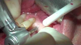 EXPLICIT  Dental implant placement with Immediate Temporary Crown [upl. by Notsa]