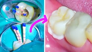 WHY Do YOU need a CROWN AFTER A ROOT CANAL PROCEDURE IS A Dental Cap and Post Necessary [upl. by Doownelg]