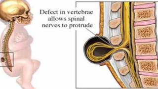 Spina Bifida [upl. by Nahraf490]