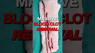 Shocking Footage Massive Blood Clot Removal From Artery shortsviral vascularsurgeon [upl. by Ardnuahc]