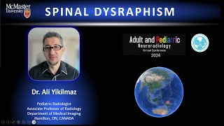 Spinal Dysraphism  brief [upl. by Aleina]