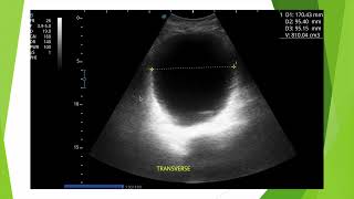 Globe vésical en échographie et piège du miroir [upl. by Nadda]
