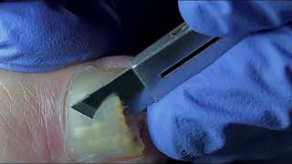 Ingrown Toenail Removal  Pedicure Treatment and Very Satisfying  Best Satisfying Nail Cutting [upl. by Nolham155]