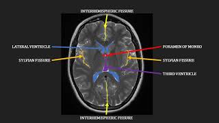 Introduction to MRI of the brain [upl. by Sosthina]