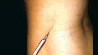 Tratamiento esclerosante de varices  Sclerosing Treatment of Varicose Veins  Sclerotherapy [upl. by Nonnahsed]