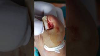 Proper technique of removing an ingrown toe nail 15sec  dermatology shorts skincare [upl. by Lyon954]