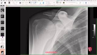 Upper Extremity Case Conference Shoulder Girdle [upl. by Gasser]