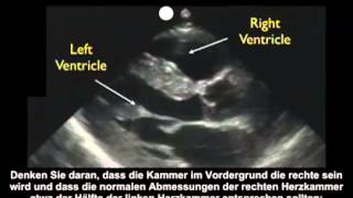 Anleitung Kardiologische Ultraschalluntersuchung – parasternal lange Achse – Teil 1 [upl. by Brenk]