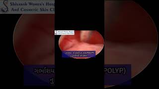 Hysteroscopic Polyp Removal [upl. by Gothar]