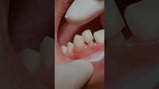 Zirconia crowns dentistry [upl. by Humfried369]