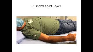 Cryoneurotomy to Reduce Spasticity amp Improve Range of Motion in Spastic Flexed Elbow [upl. by Colt391]