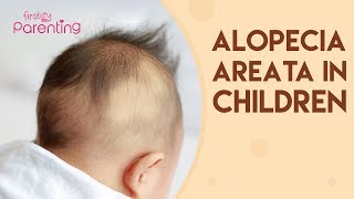 Alopecia Areata in Children  Causes Signs amp Treatment [upl. by Hairehcaz]