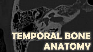 Anatomy of the Temporal Bone on Imaging [upl. by Bannister833]