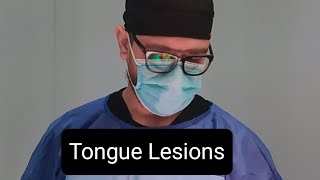 OMFS Tongue lesions [upl. by Claudianus]