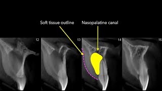 Nasopalatine Canal [upl. by Behn]