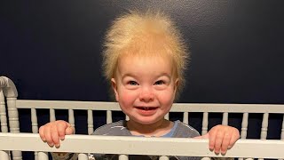 Baby Has Rare ‘Uncombable Hair Syndrome’ [upl. by Aydiv336]