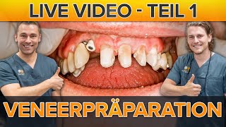 VENEERS Präparation mit Provisorium inkl LIVE VIDEO Teil 1 [upl. by Benedick]