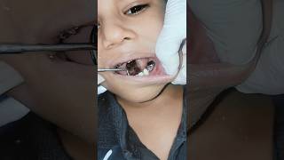 Space Maintainer For Kids Teeth trending shorts shortfeed bestdentalclinic bestdentist dr [upl. by Allicerp]