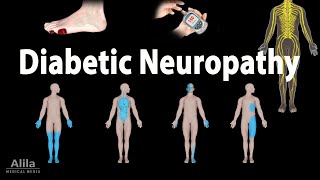 Diabetic Neuropathy Animation [upl. by Seira]