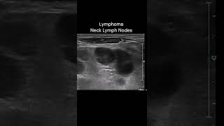 Neck Lymph Nodes  3 ultrasound imaging cases lymphoma [upl. by Lekkim]