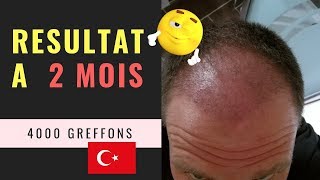 Greffe de cheveux FUE en Turquie Vidéo 10  Résultat à 2 mois  4000 Greffons [upl. by Caundra]