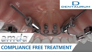 amda®  compliancefree treatment advanced molar distalization appliance [upl. by Garner]