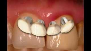 What is the Suclus  Gingiva [upl. by Robers]